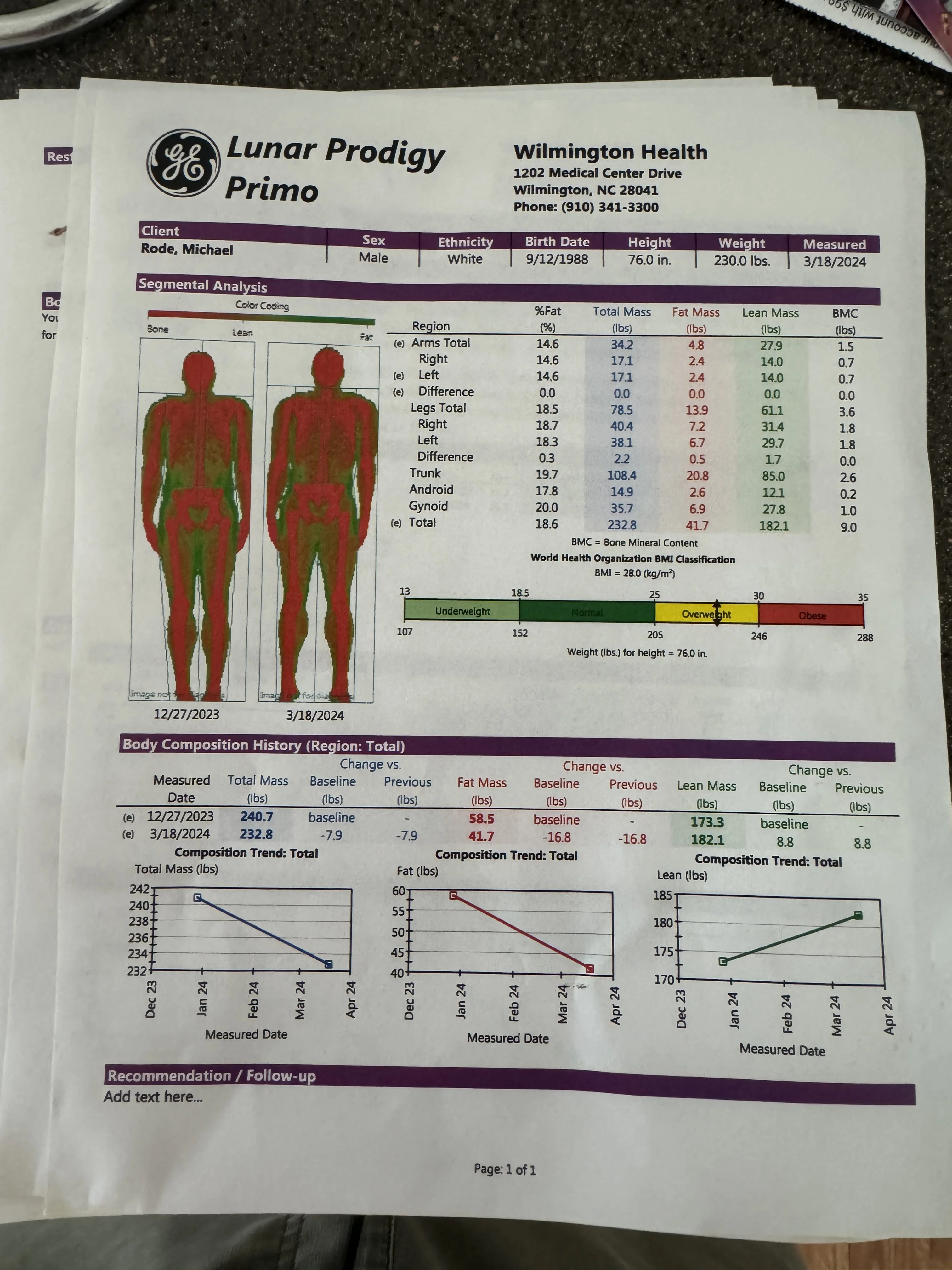 Real GE Lunar Prodigy DEXA report showing total and regional body fat percentage, fat mass, lean mass, and bone mineral content